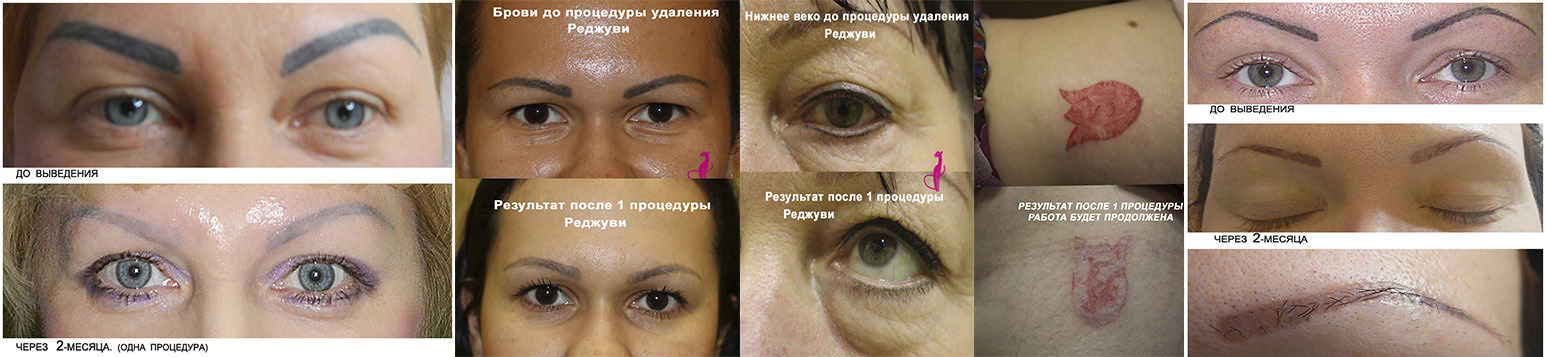 Удаление татуажа процесс Удаление татуажа процесс